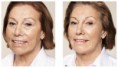 /album/fore-och-efter-behandling-med-restylane/ba-09-2012-1-jpg/